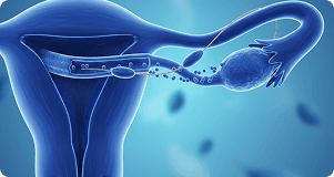 Endometriotic cyst ablation