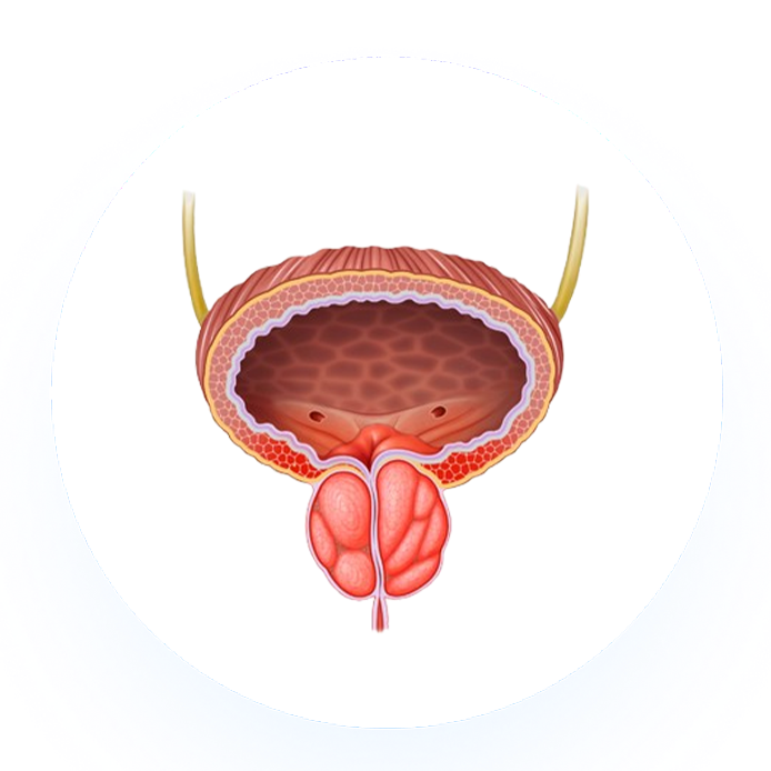 Prostate Artery Embolization (PAE)