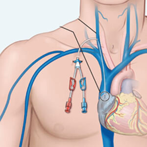 Fallopian Tube Recanalization