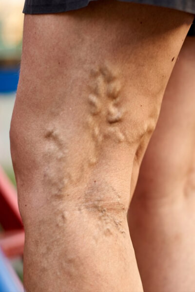 Varicose Vein Ablation