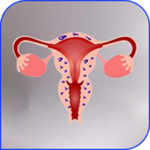 Adenomyosis